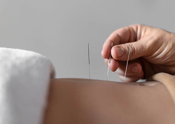 Acupuncture Treatments at Sea to Sky Physio