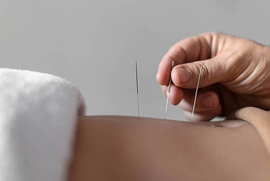 Acupuncture Treatments at Sea to Sky Physio